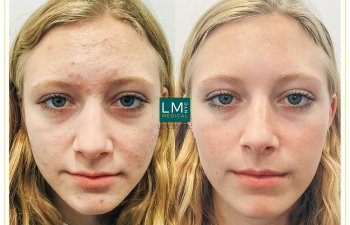 Female patient before and after acne treatment