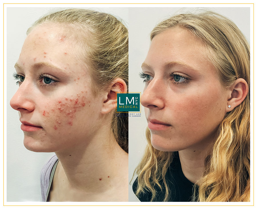Skin Before After Gallery Lm Medical Nyc