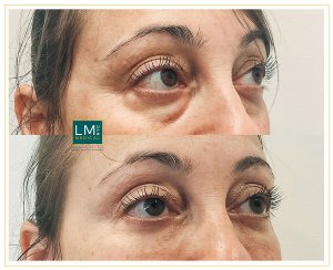 Eye and Brow - LM Medical NYC