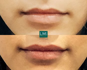 🥇 Lip Filler - Before & After Gallery