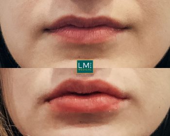 LM Filler – LM Professional