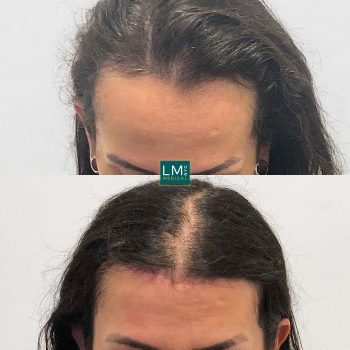 Hair Transplant and Hairline Lowering - Before & After Gallery | LM ...