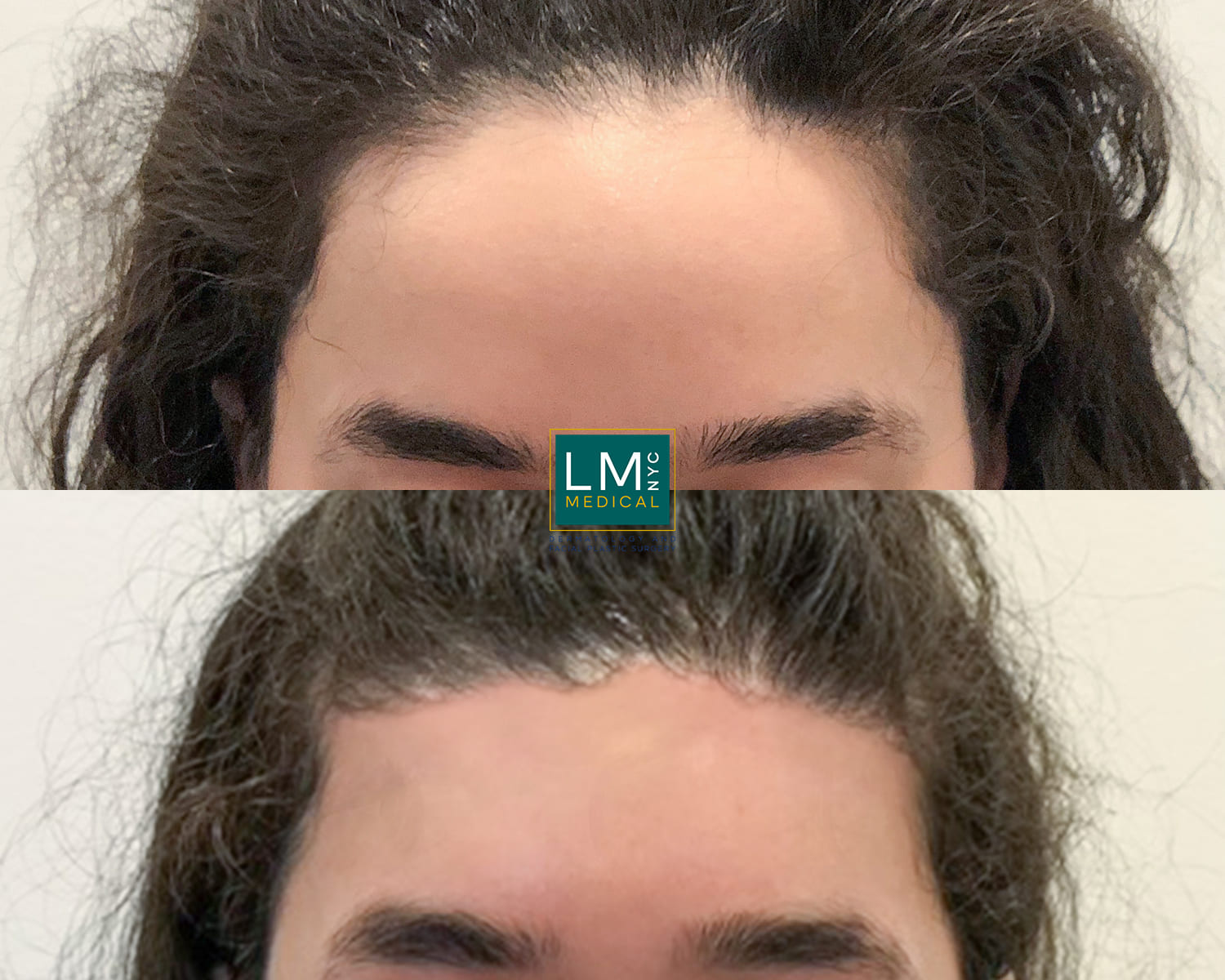 Hair Transplant And Hairline Lowering Before And After Gallery Lm