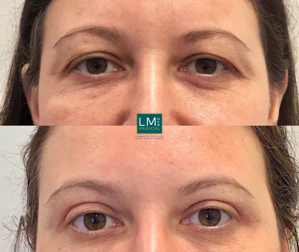 Eye and Brow – Before & After Gallery
