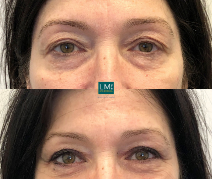 Eye and Brow – Before & After Gallery