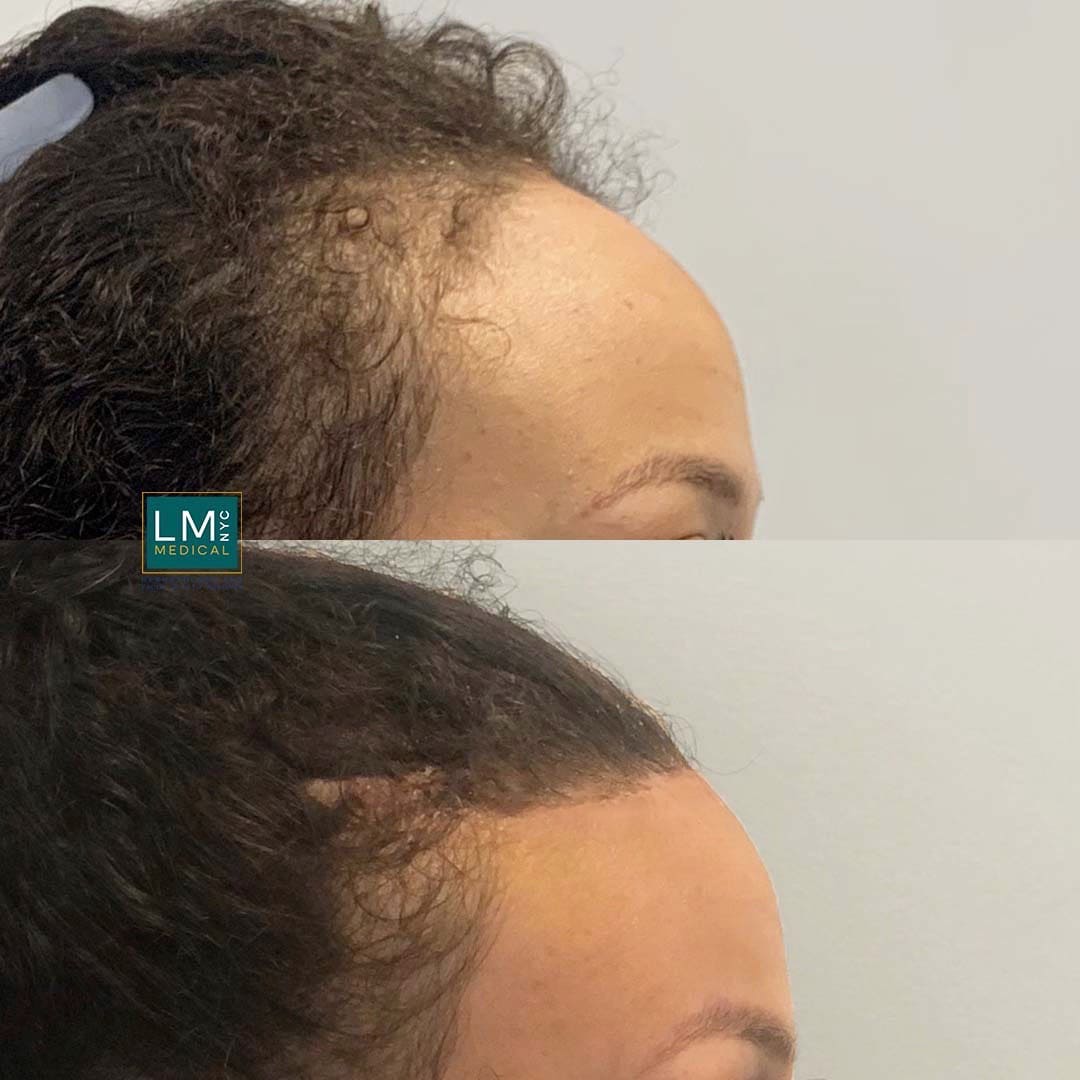 Hair Transplant And Hairline Lowering Before And After Gallery Lm