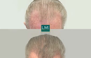 Male hair transplant before and after.