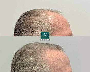 Hair Transplant and Hairline Lowering - Before & After Gallery - LM Medical  NYC