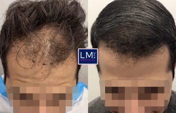patient before and after hair procedure