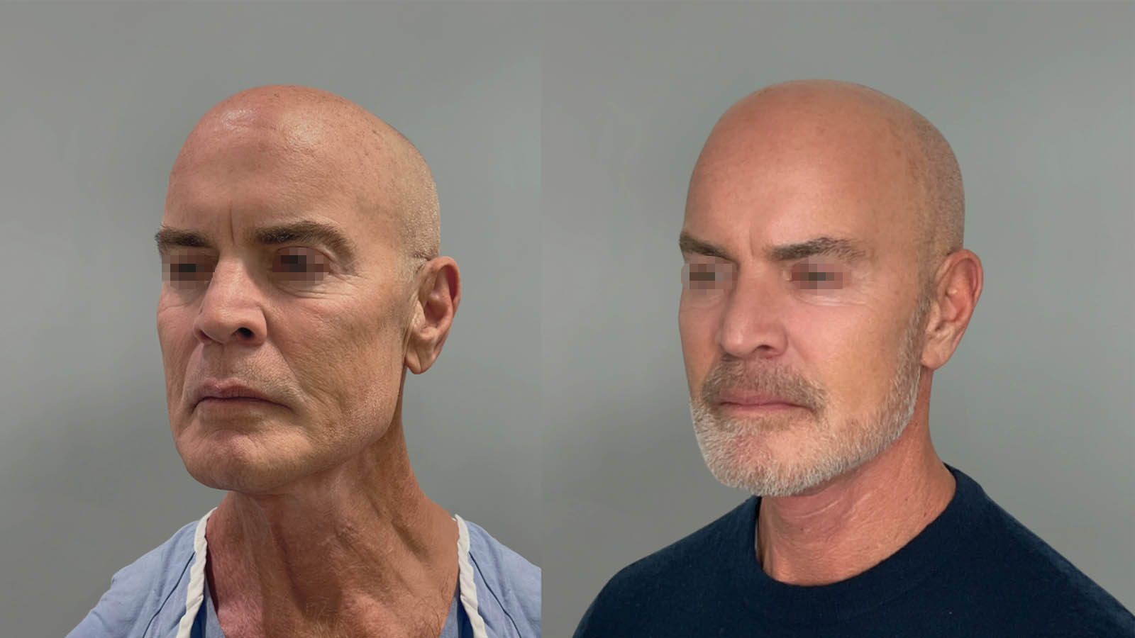 1_0000_facelift001of27.jpg