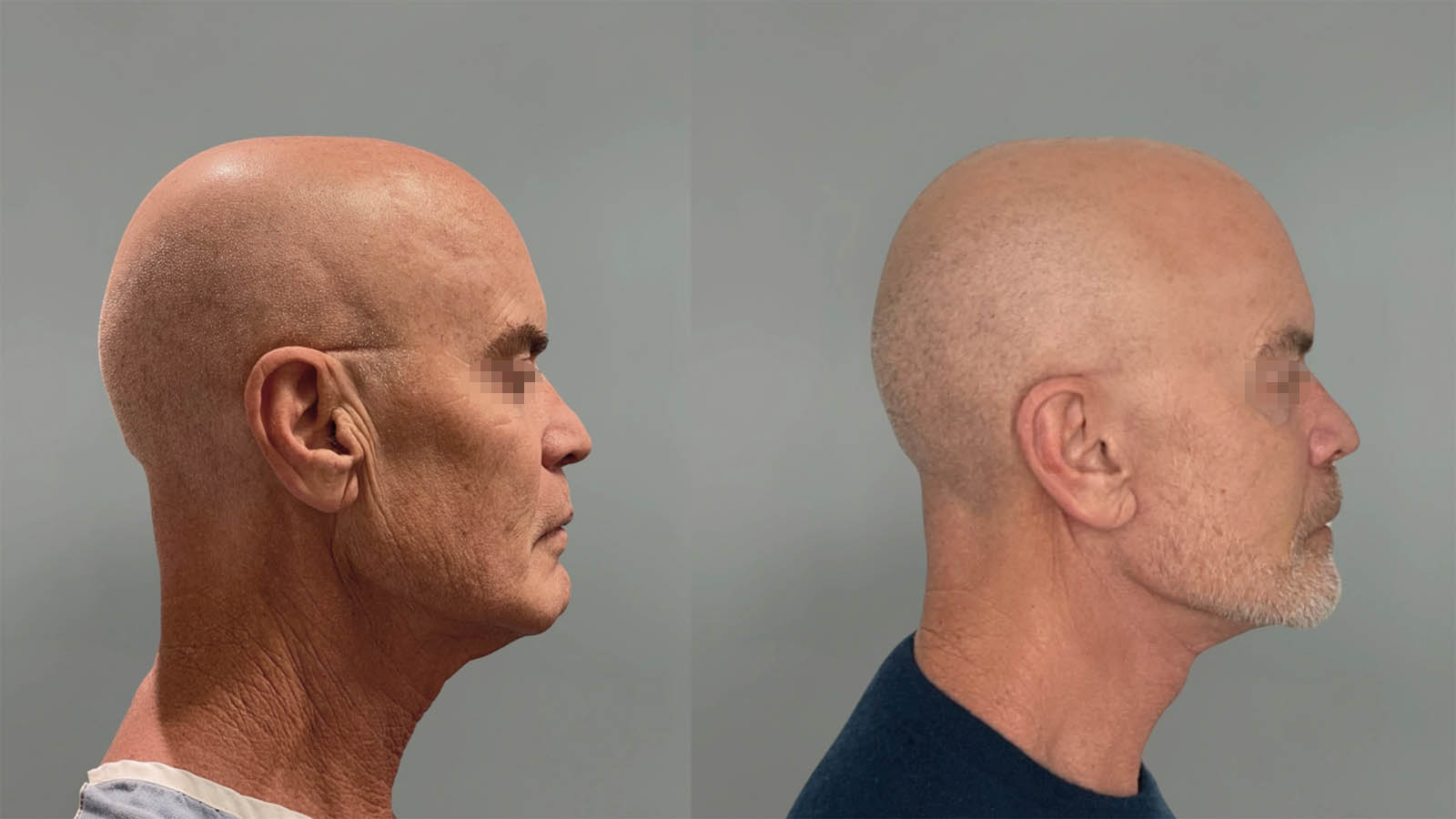 1_0004_facelift005of27.jpg