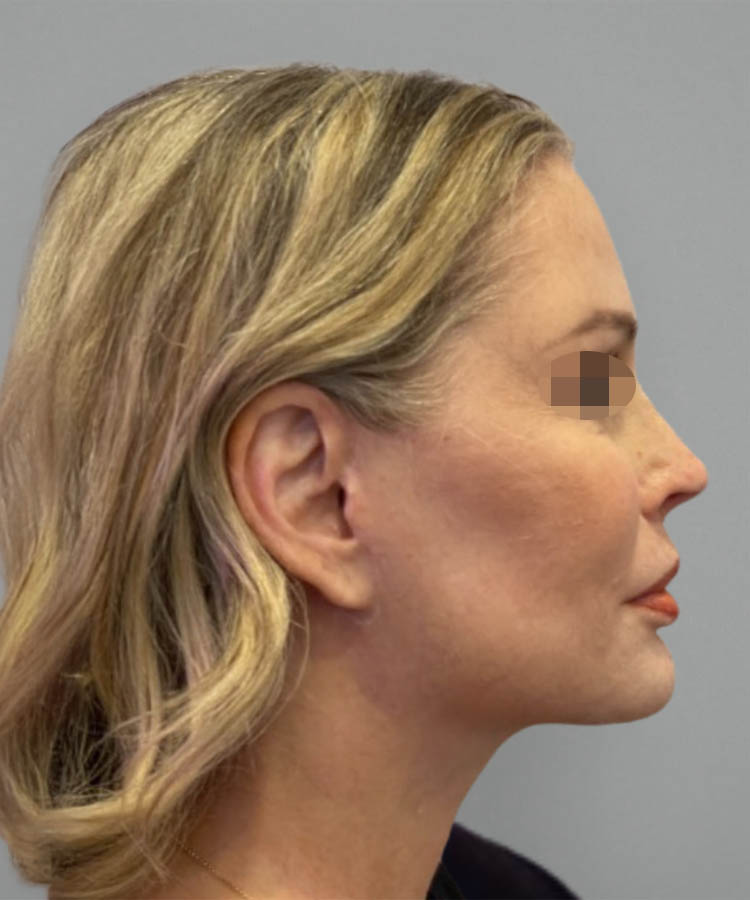 1_0009_Facelift1-5.png