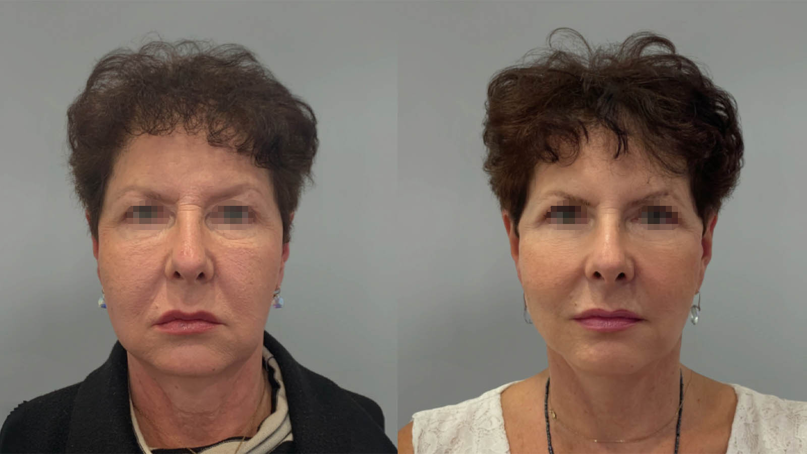 1_0034_facelift036of27.webp