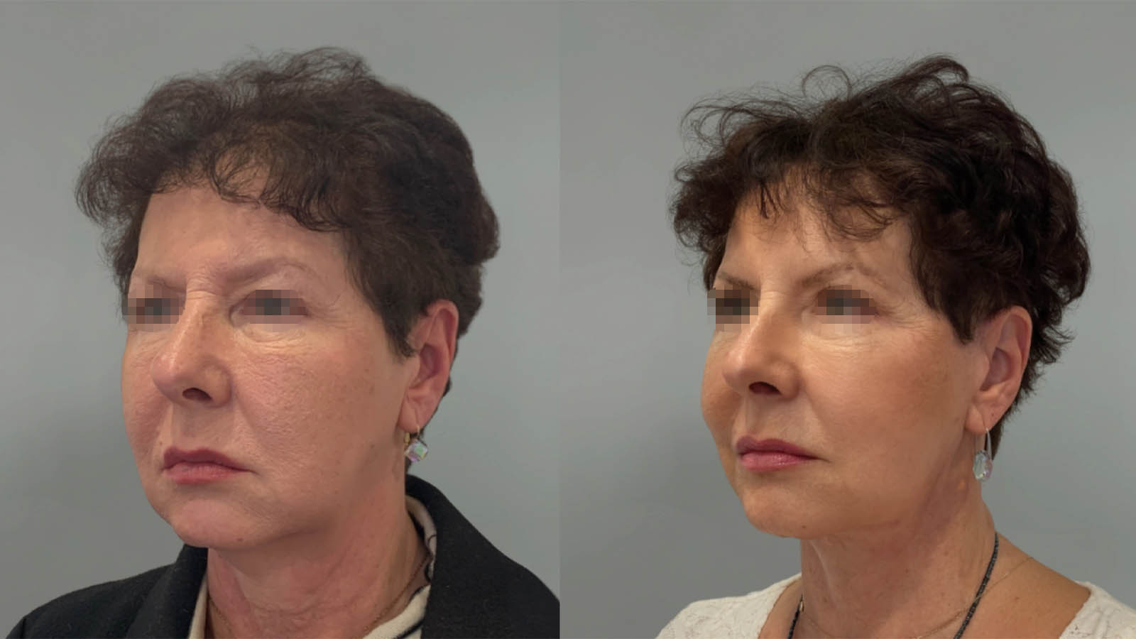1_0036_facelift038of27.webp