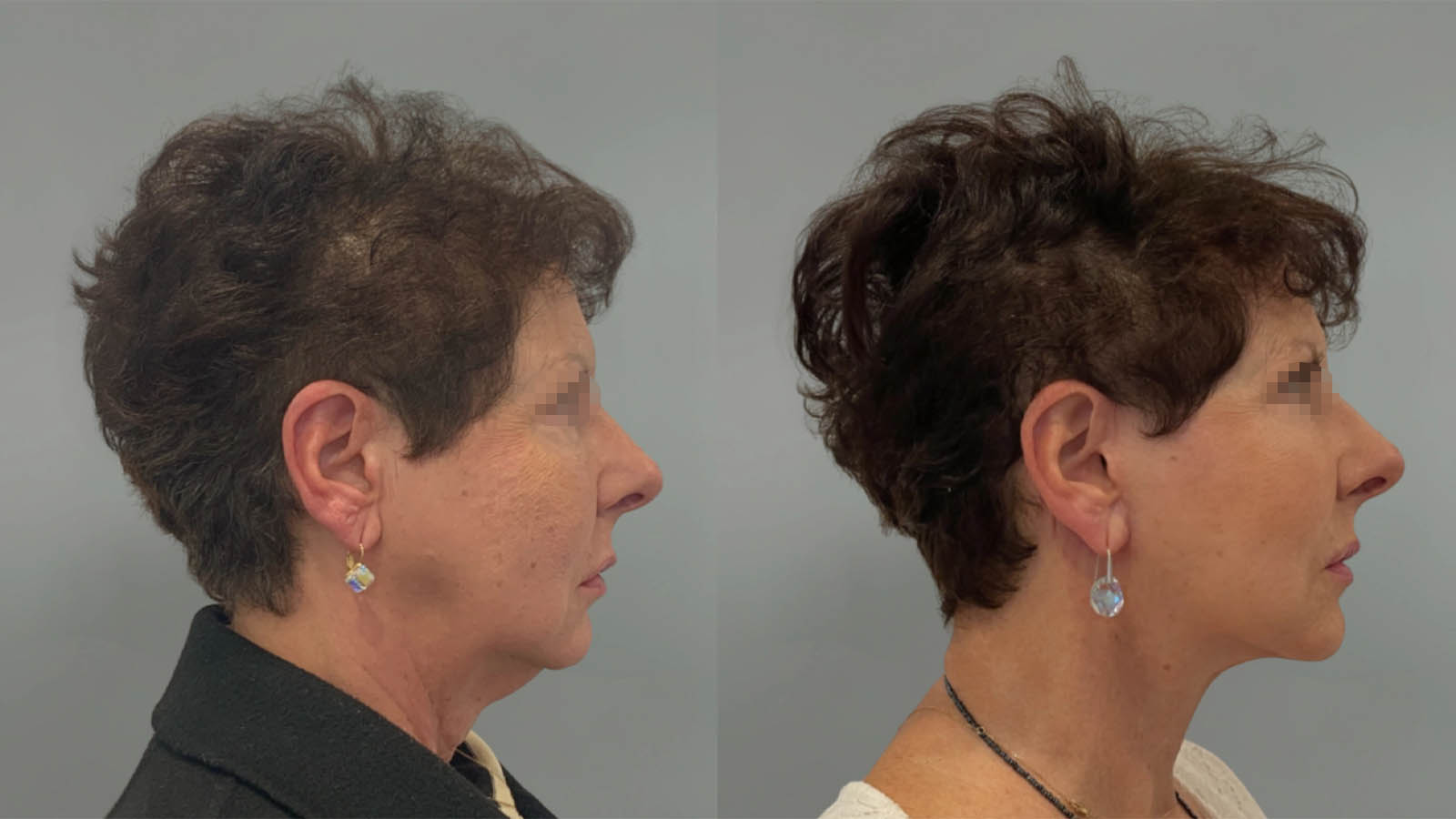 1_0037_facelift039of27.webp