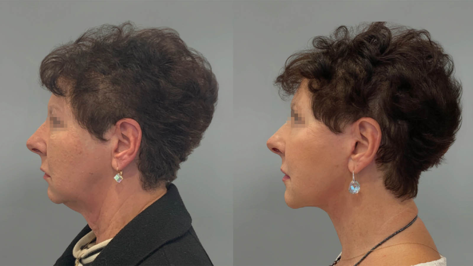 1_0038_facelift040of27.webp