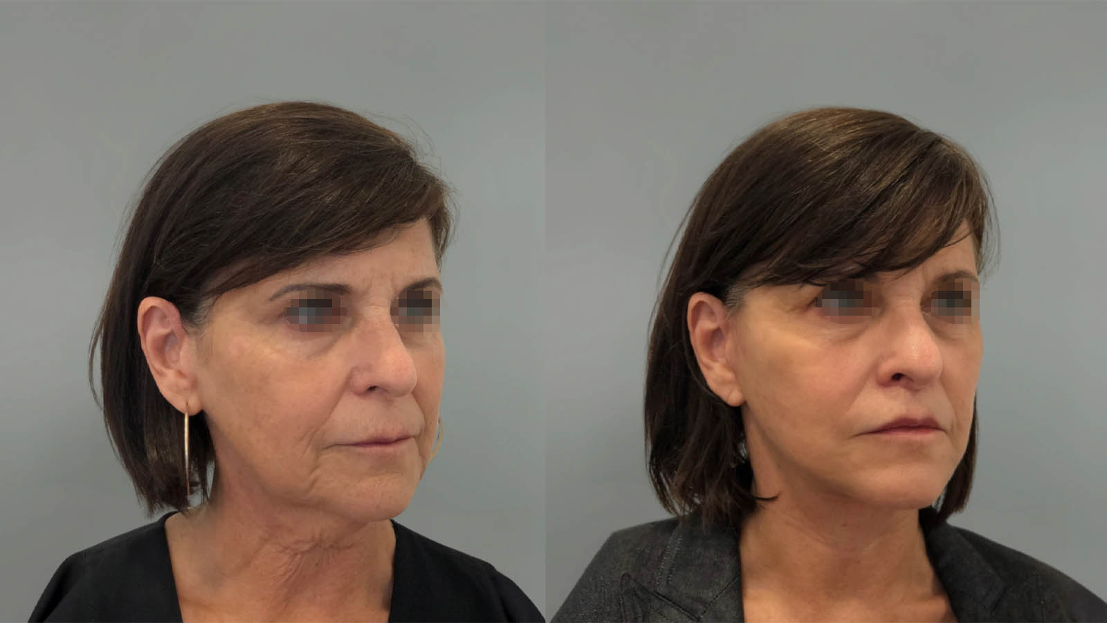 1_0045_facelift047of27.webp