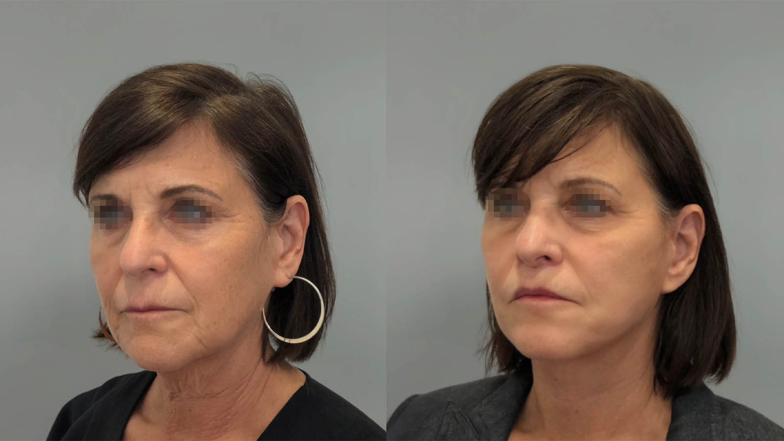 1_0046_facelift048of27.webp
