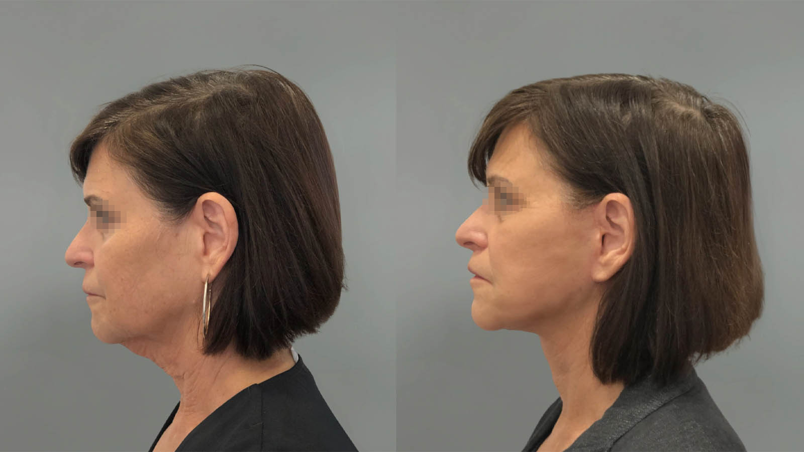 1_0047_facelift049of27.webp