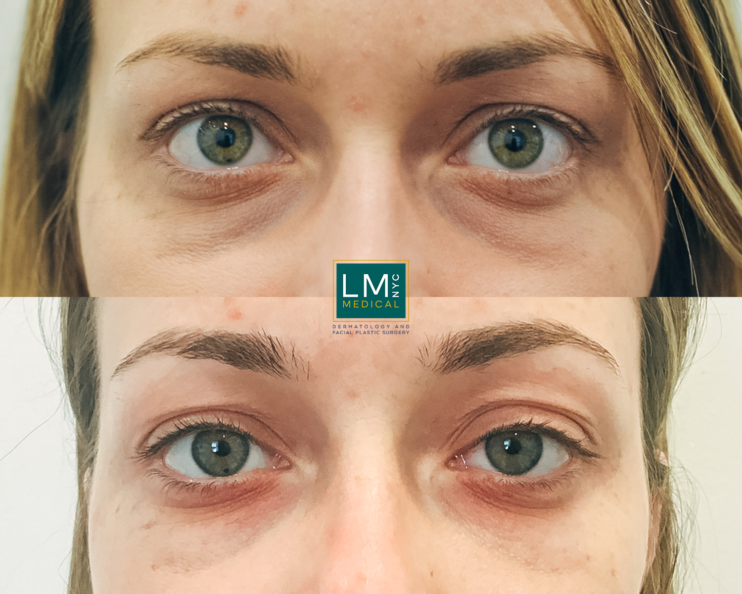 UnderEyeFiller14