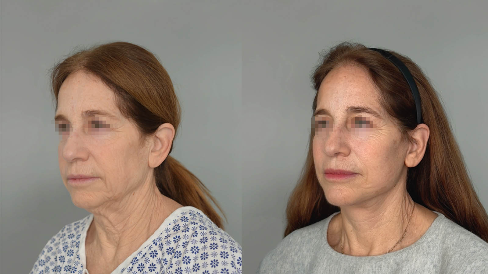 1_0019_facelift020of27.jpg