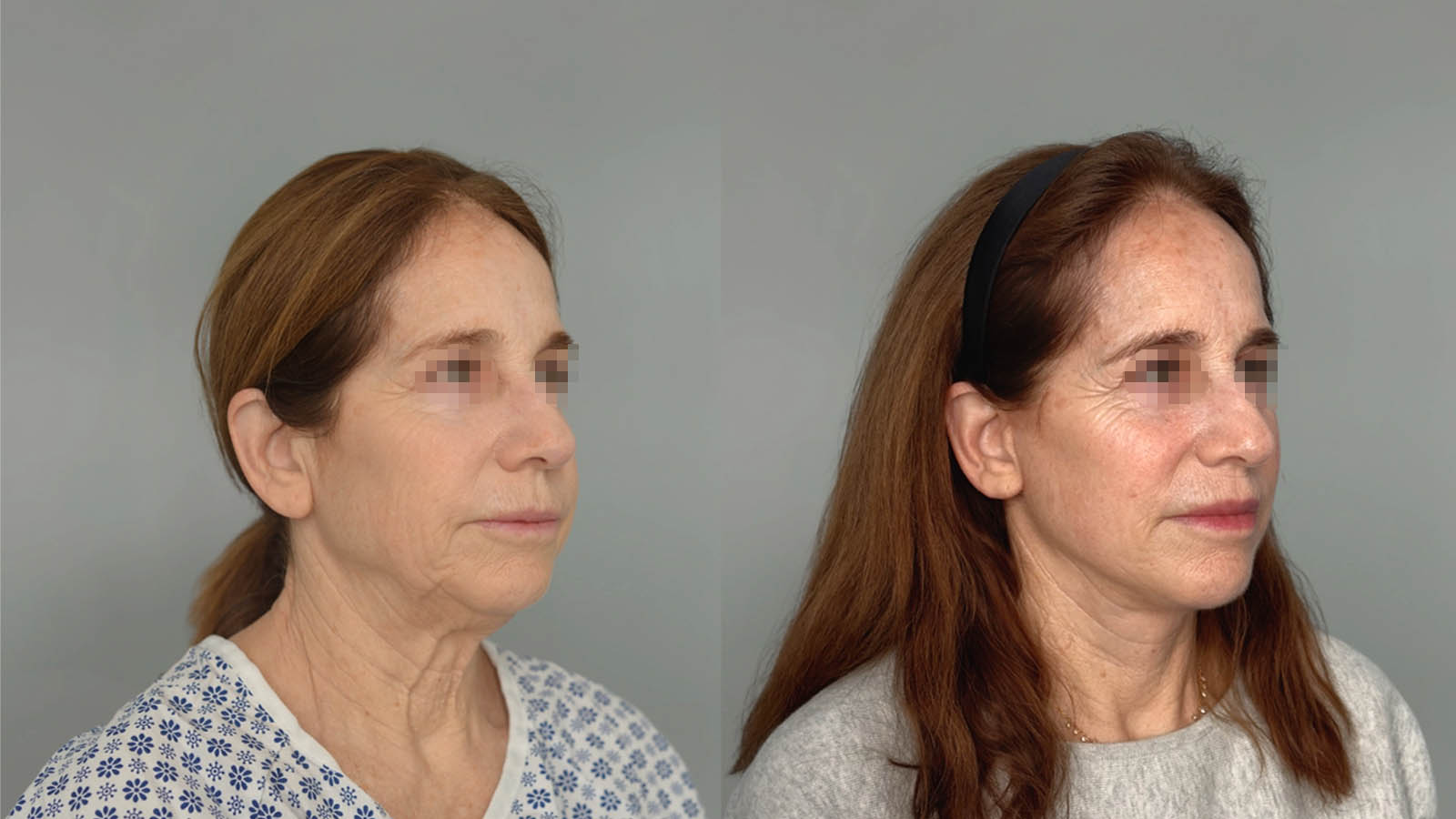 1_0020_facelift021of27.jpg