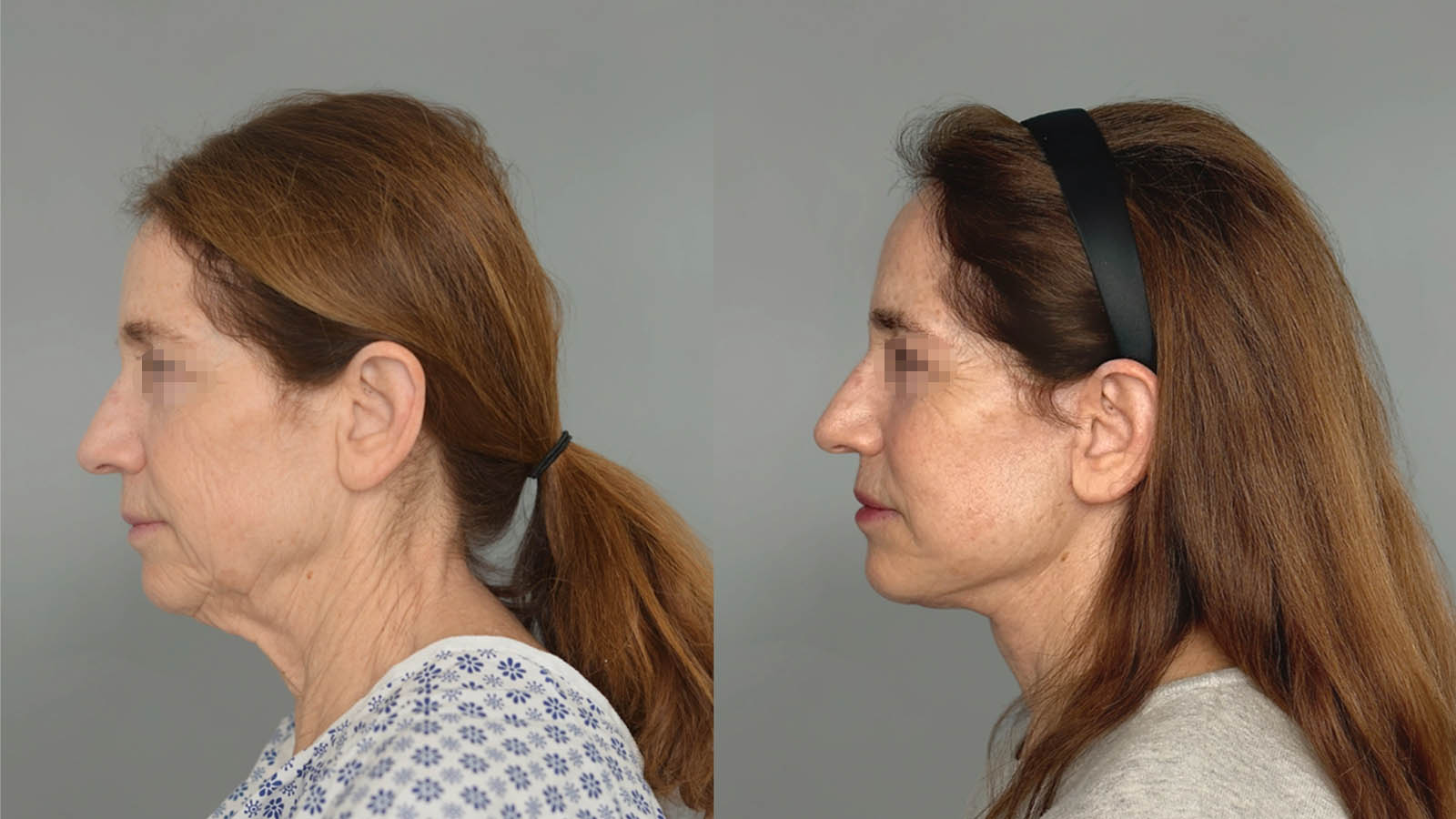 1_0022_facelift023of27.jpg