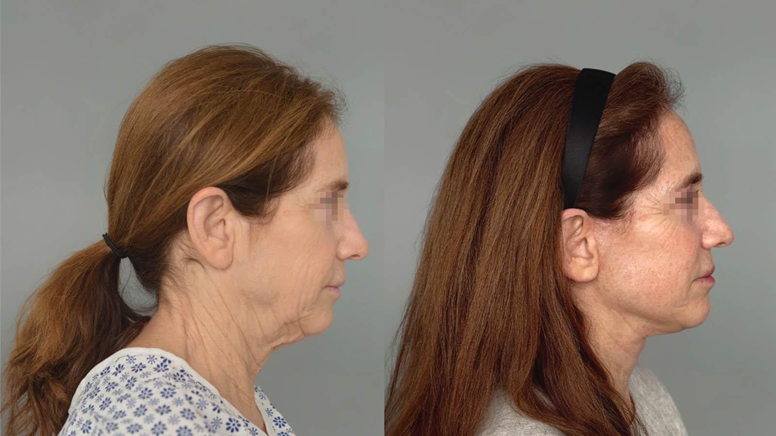 1_0023_facelift024of27.jpg