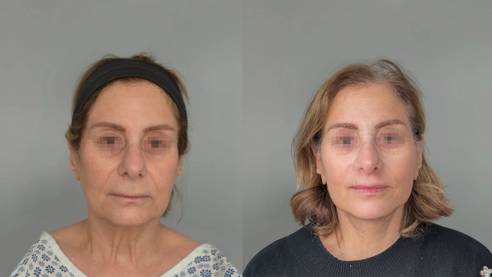 1_0039_facelift041of27.webp
