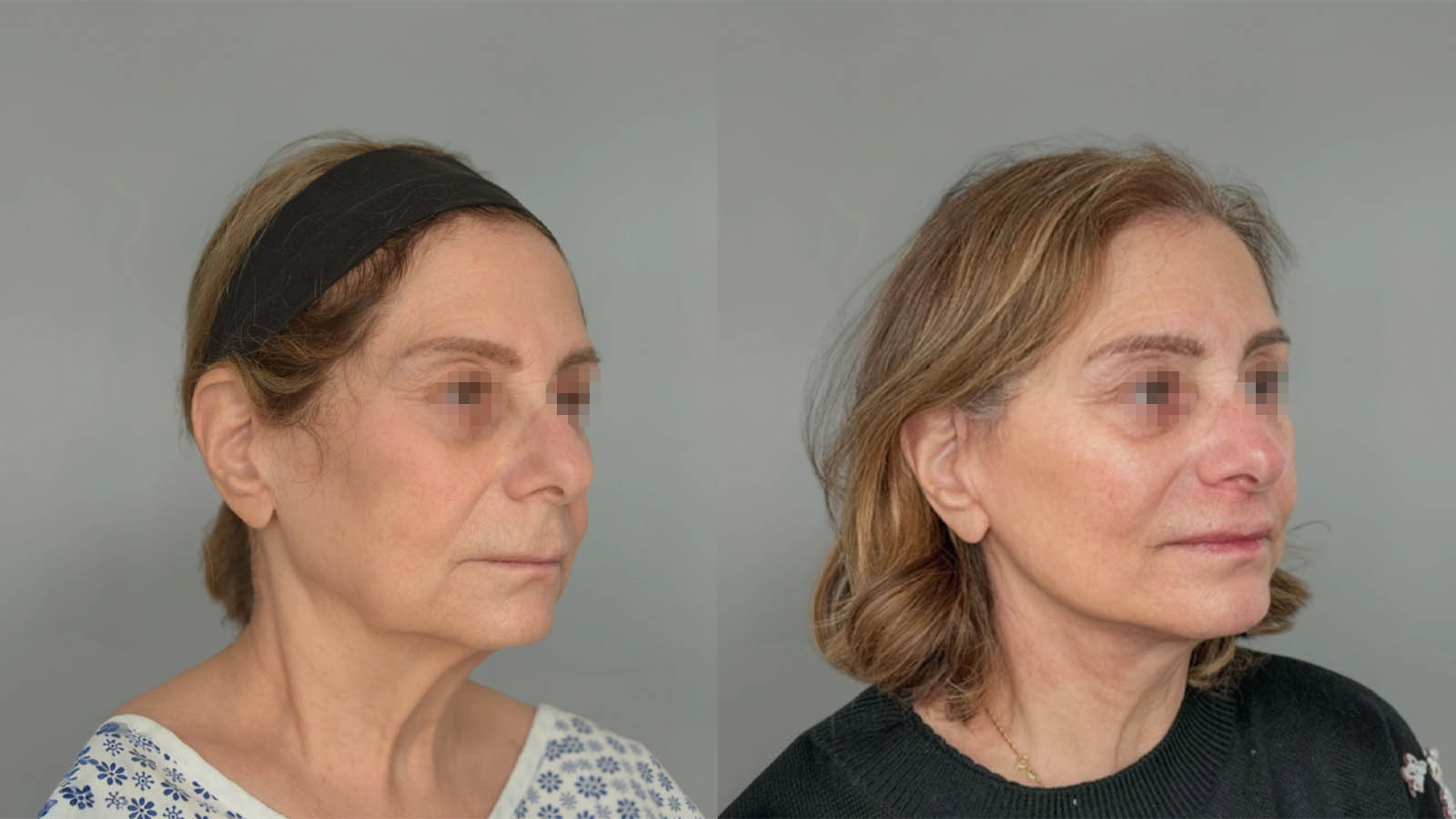 1_0040_facelift042of27.webp