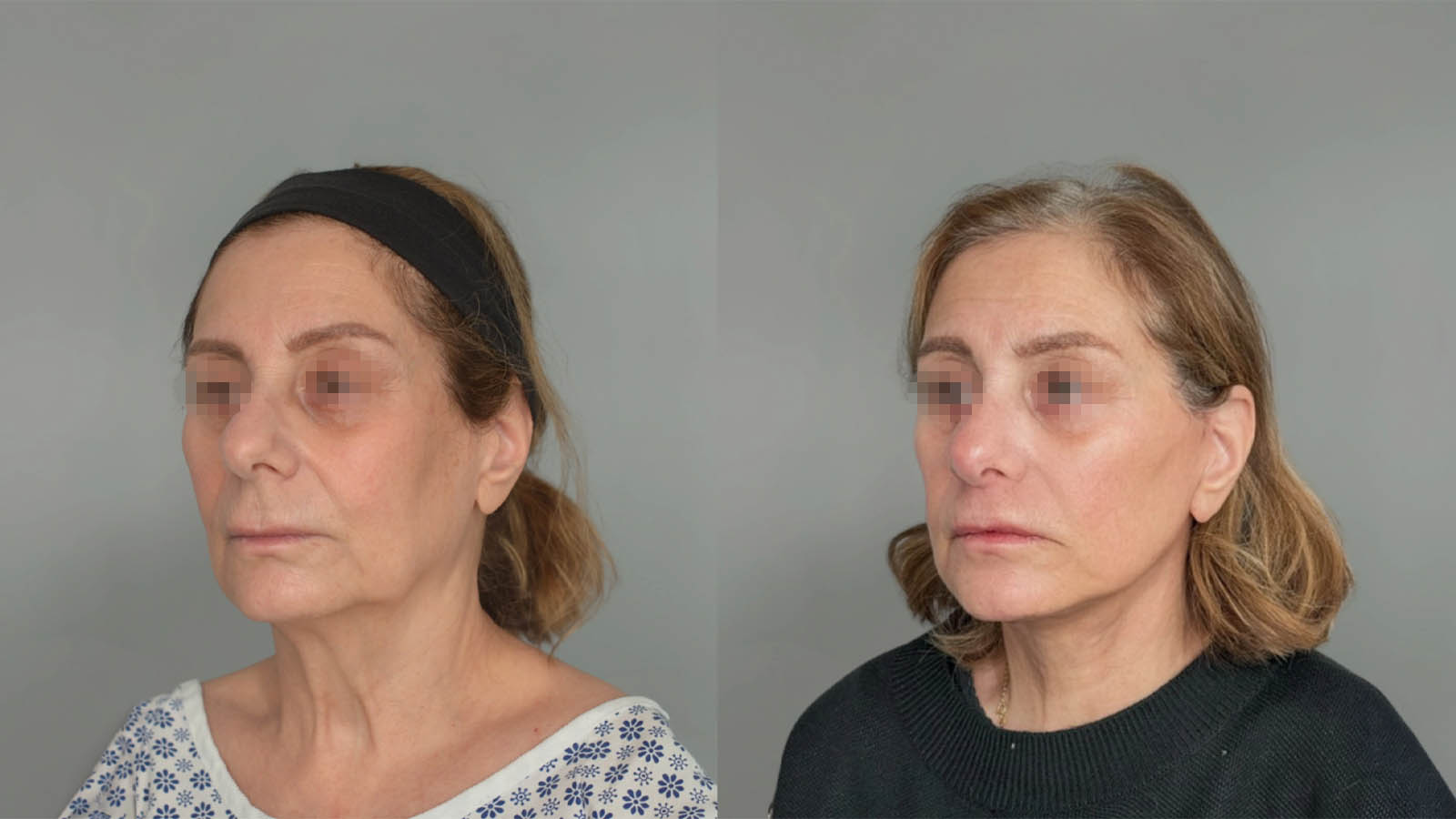 1_0041_facelift043of27.webp