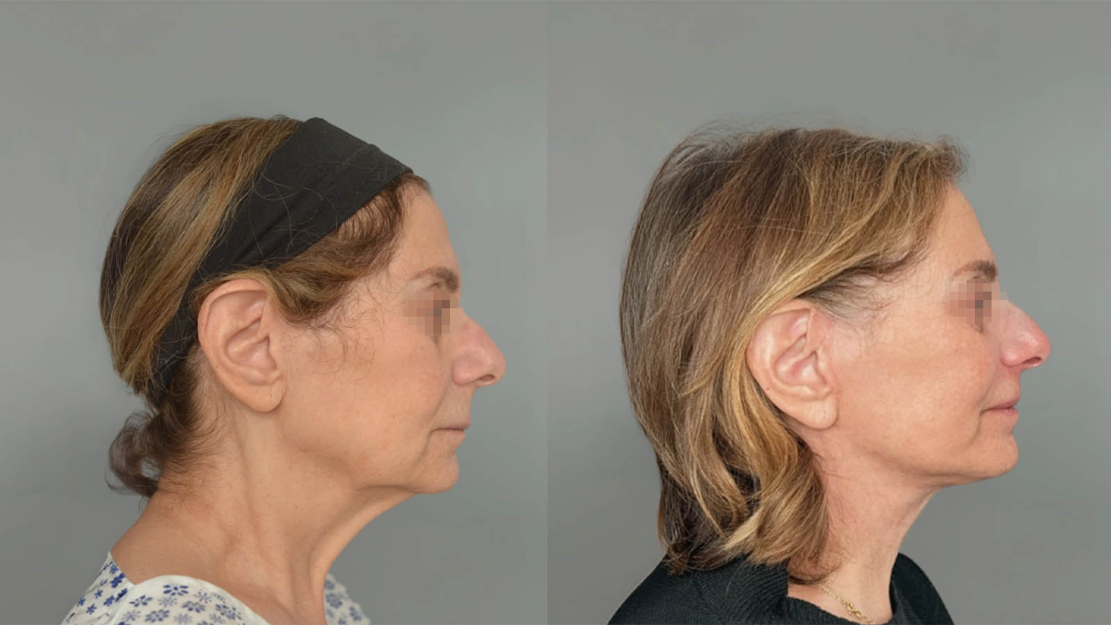 1_0042_facelift044of27.webp