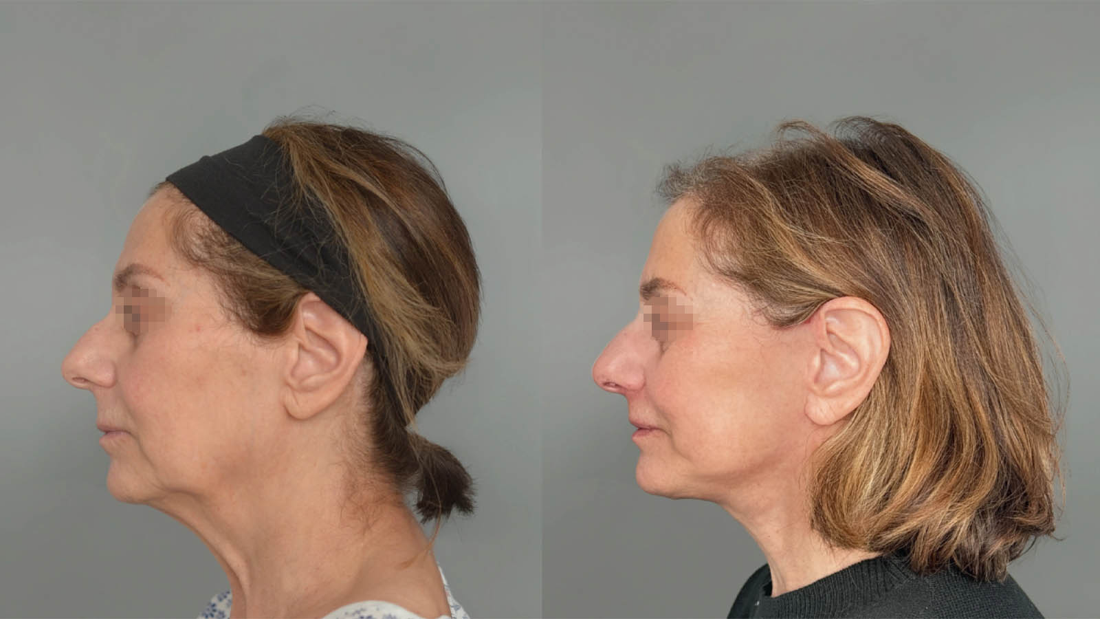 1_0043_facelift045of27.webp