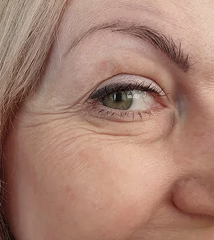 Woman's eye and face showing crow's feet wrinkles and aging skin around eye area