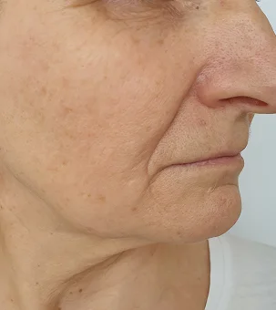 Woman's face showing aging signs with wrinkles and sagging skin around mouth and jawline