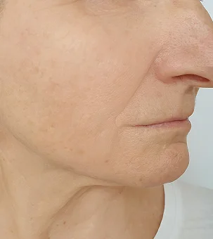 Close-up of smooth facial skin showing cheek, jawline and chin area with clear complexion