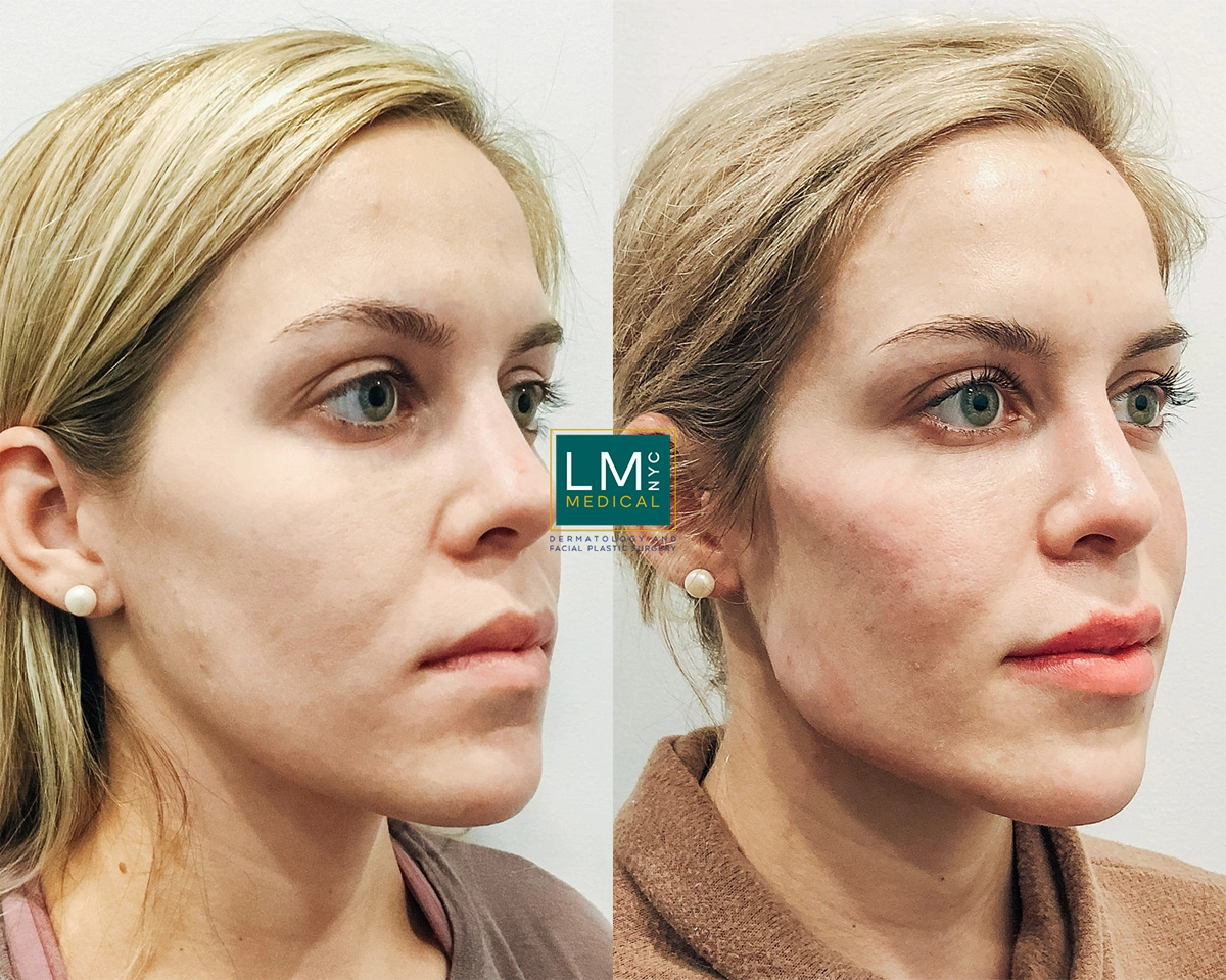 CheekJawFiller1.jpg