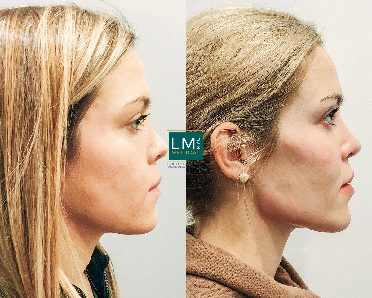 CheekJawFiller2.jpg