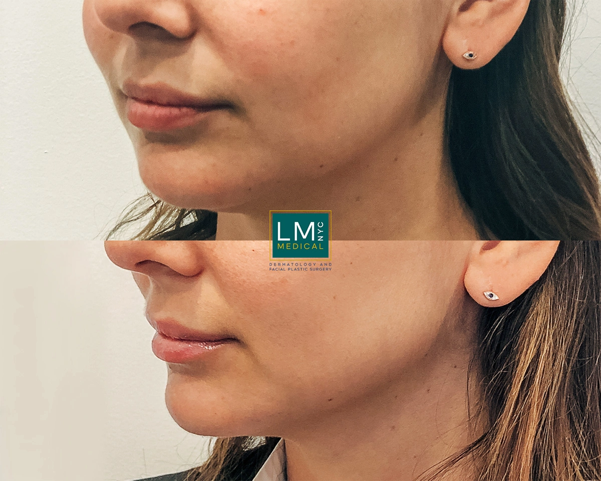 ChinLipJawFiller1.jpg