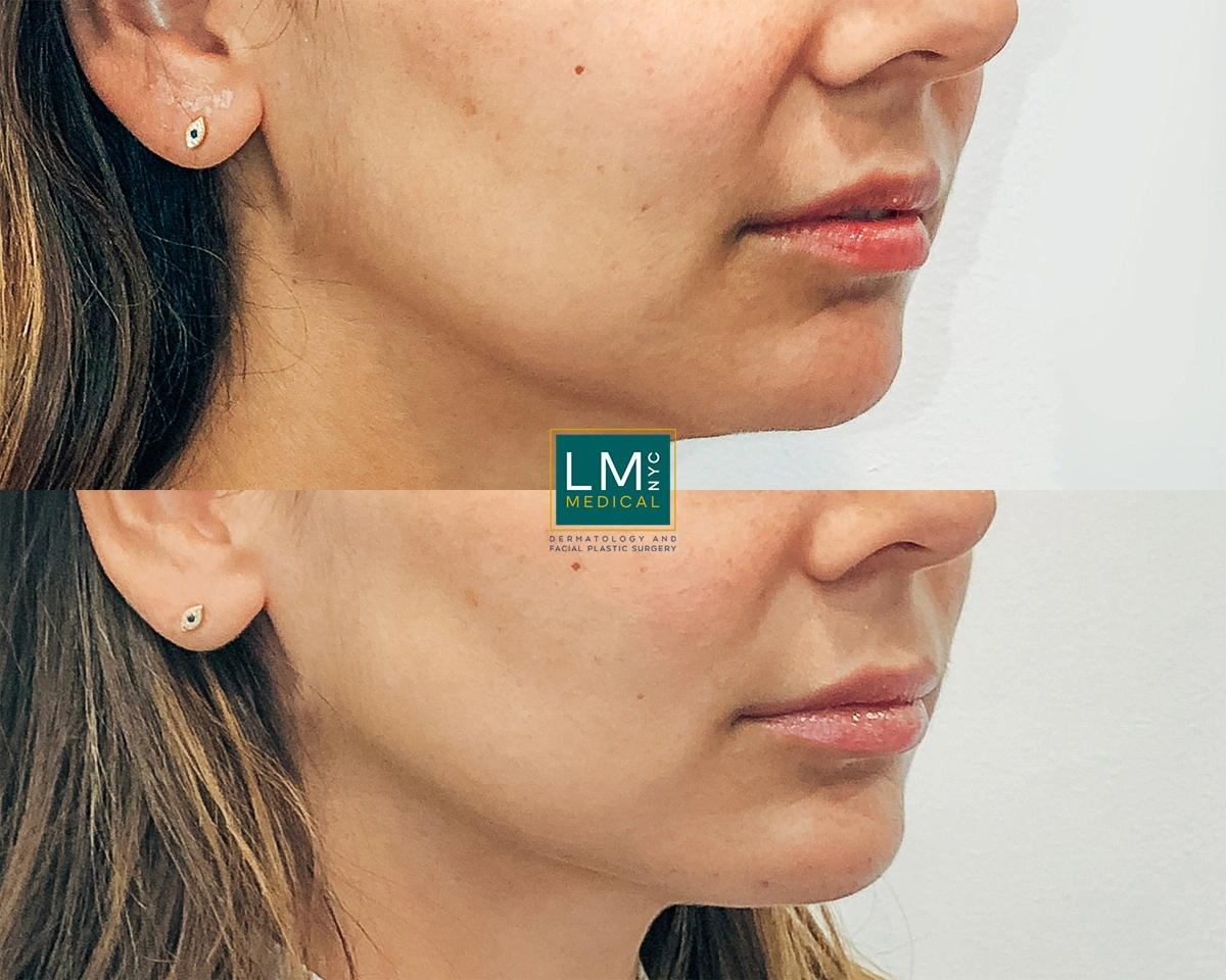 ChinLipJawFiller2.jpg
