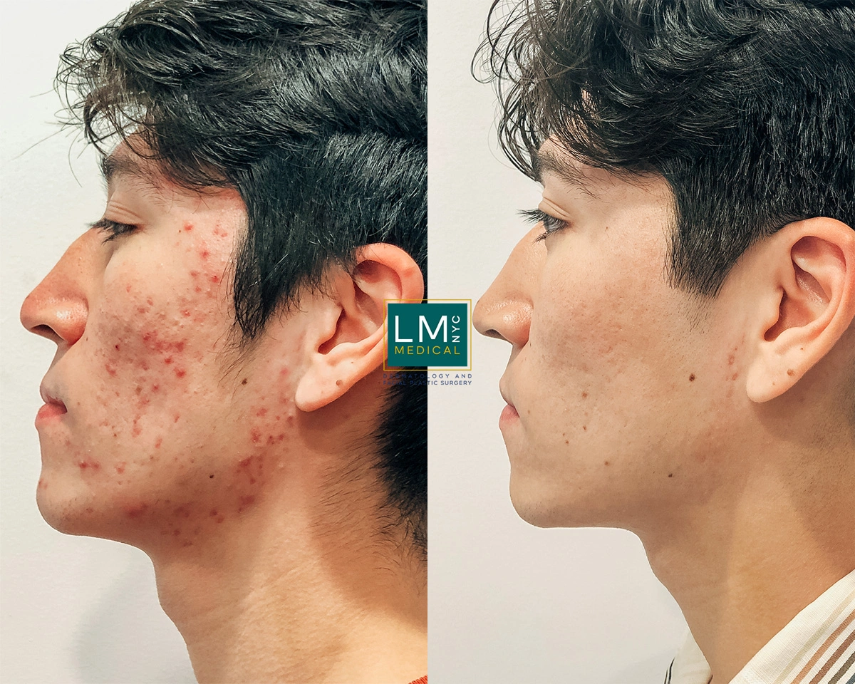 FaceAcne1.jpg