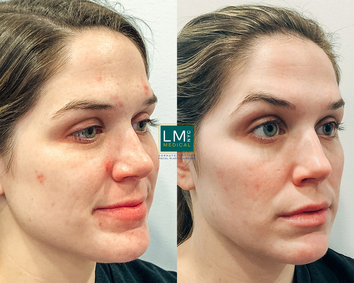 FaceAcne10 (1).jpg