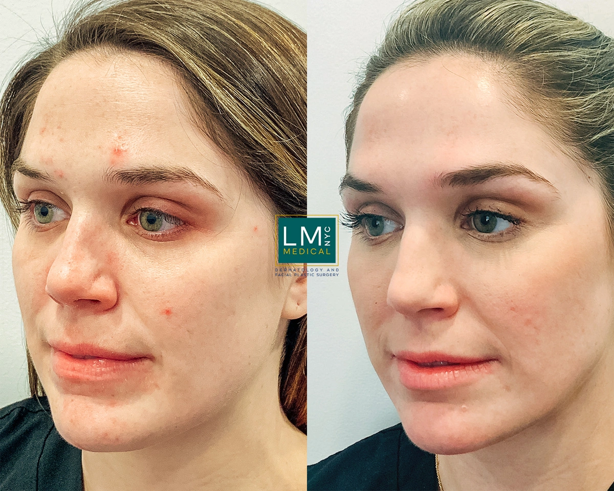 FaceAcne11 (1).jpg