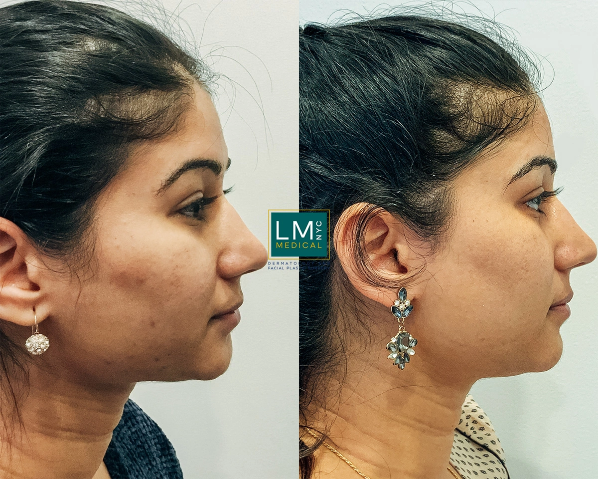 FaceAcne13.jpg