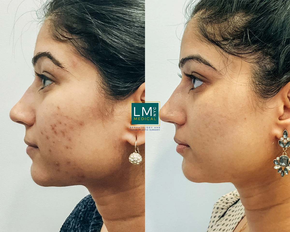 FaceAcne14.jpg