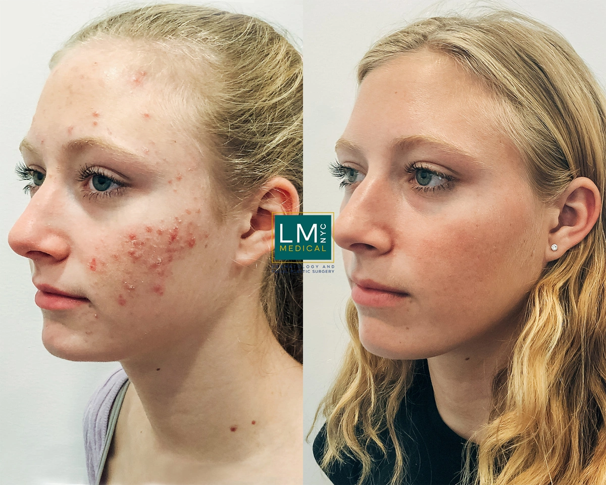 FaceAcne16.jpg