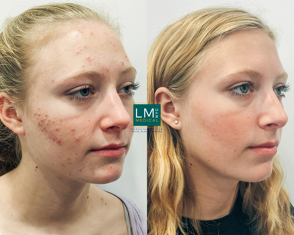 FaceAcne17.jpg