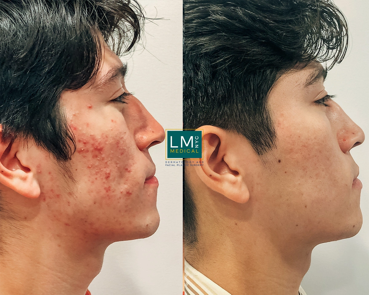 FaceAcne2.jpg