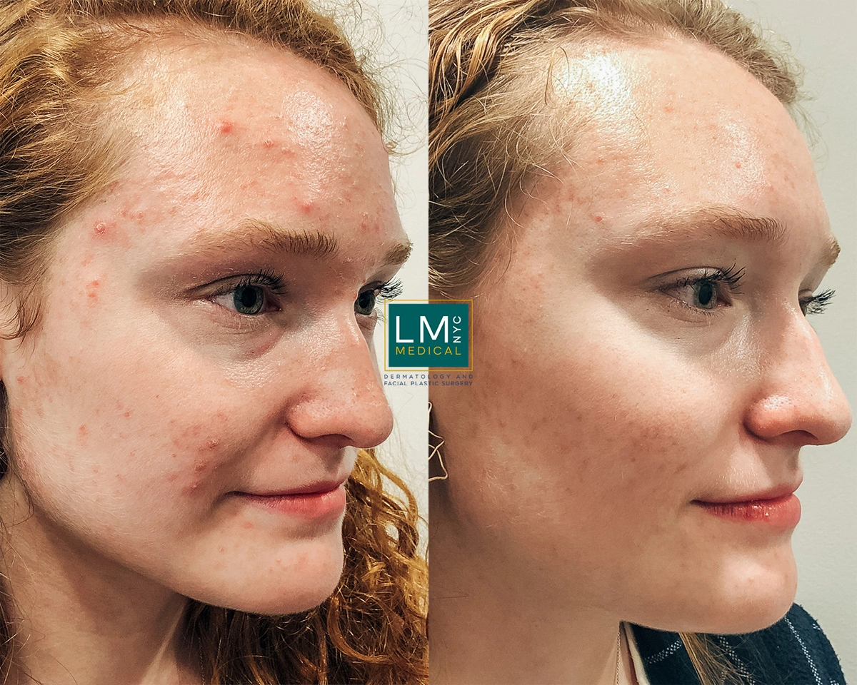 FaceAcne6.jpg