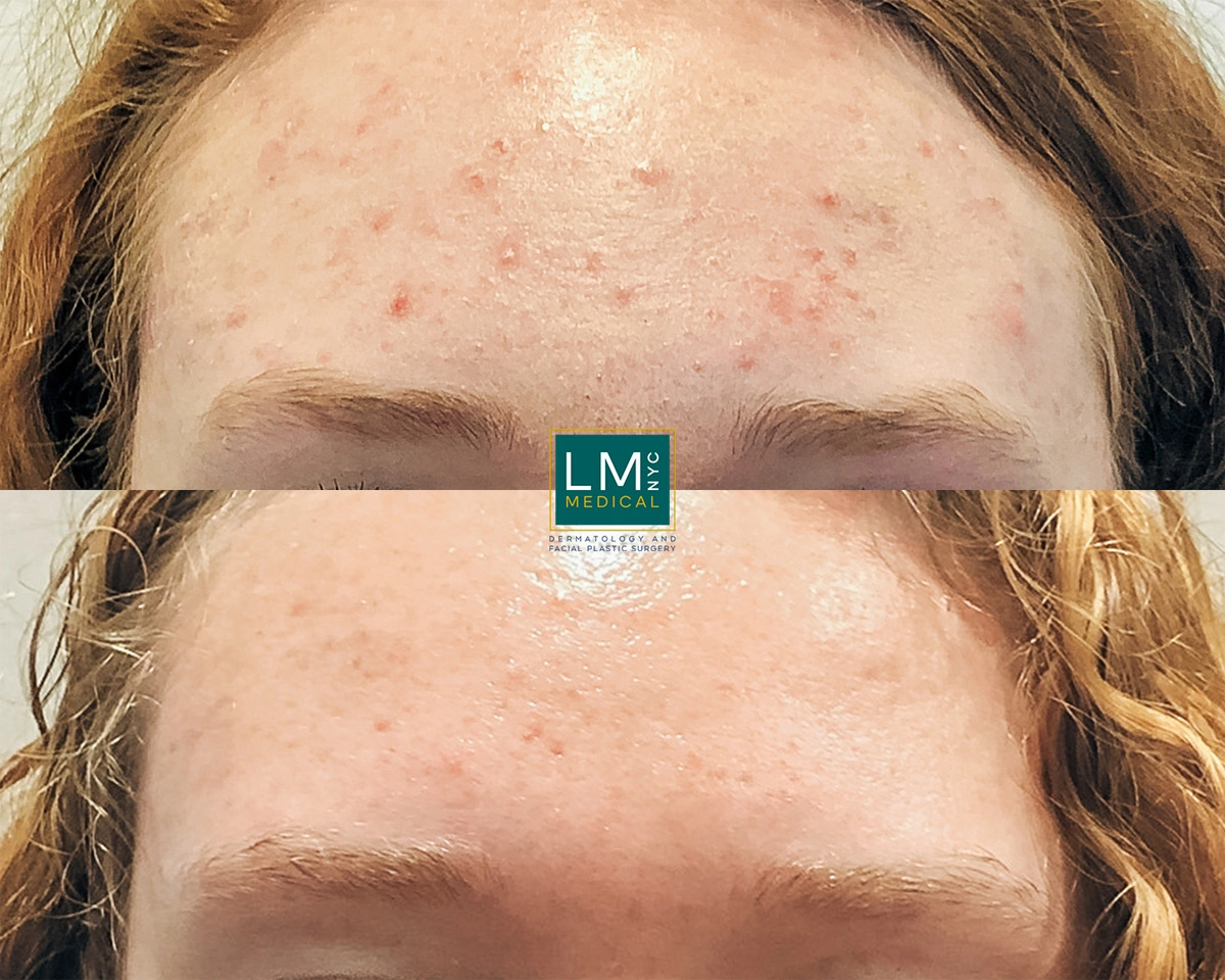 FaceAcne7.jpg